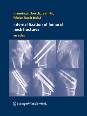 cover image of Internal fixation of femoral neck fractures